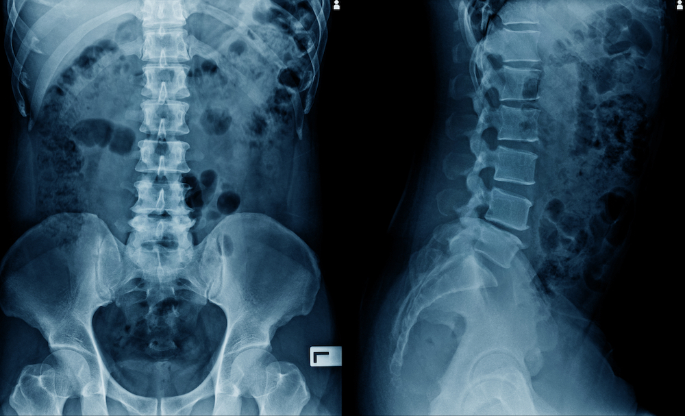 spine xray result